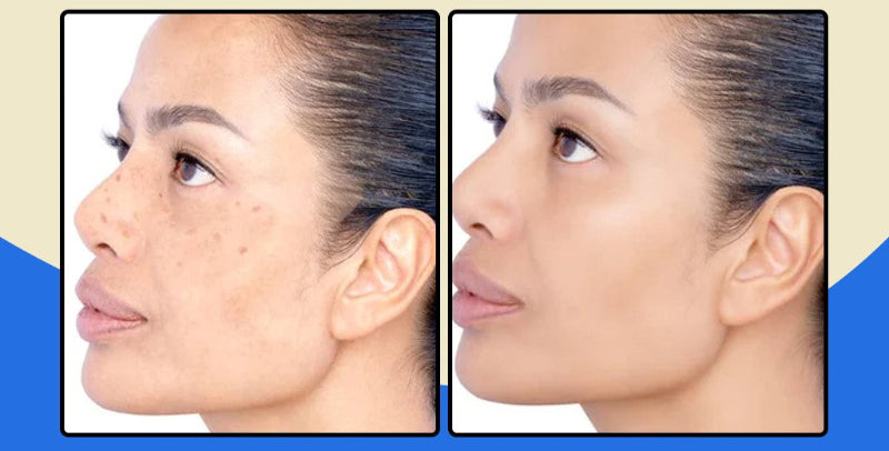 FaceClean Pro Tira Manchas - Pomada Clareadora de Manchas, Melasmas e Sinais