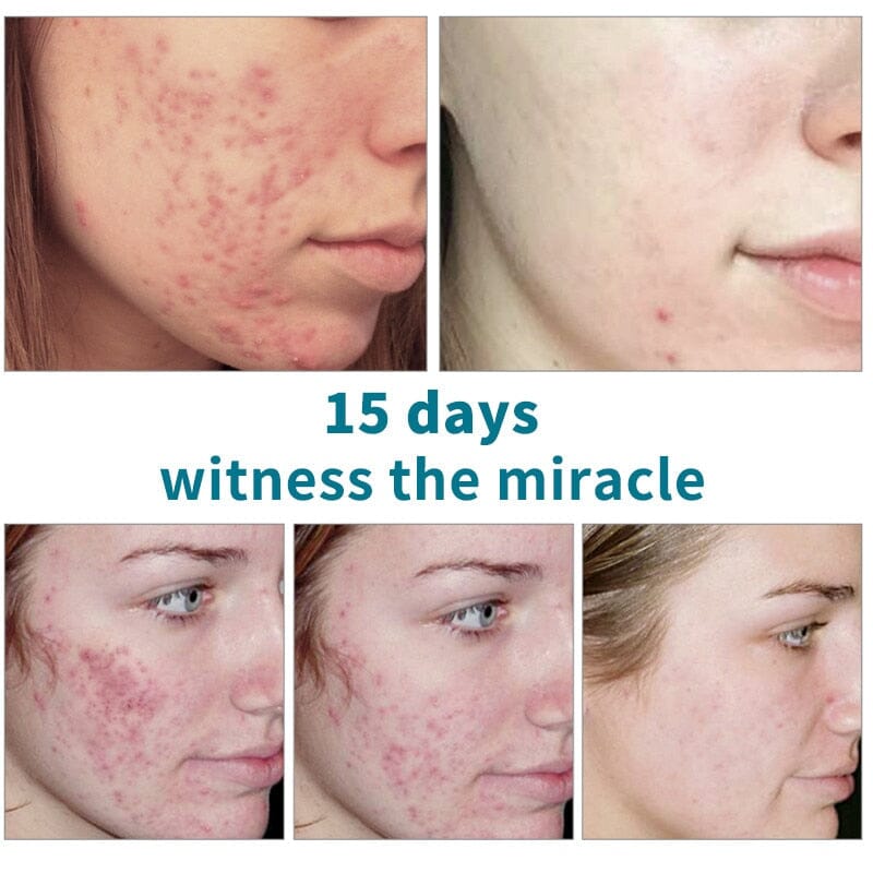 Sérum Para Tratamento Anti-Acne Com Ácido Salicílico 15ML Skin Care