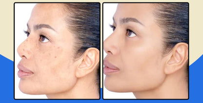 FaceClean Pro Tira Manchas - Pomada Clareadora de Manchas, Melasmas e Sinais