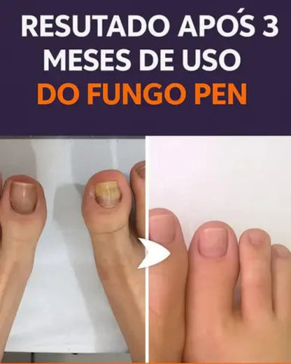 Fungo Pen – Caneta para Cuidados com as Unhas | Kaype Store