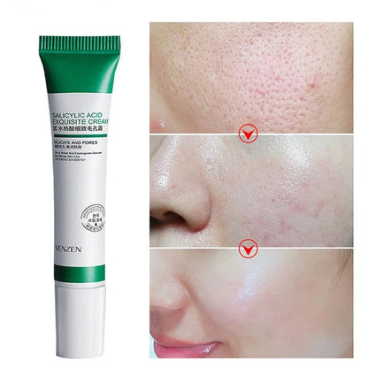 Creme Para Remoção De Poros E Clareamento de Manchas - PoroClean