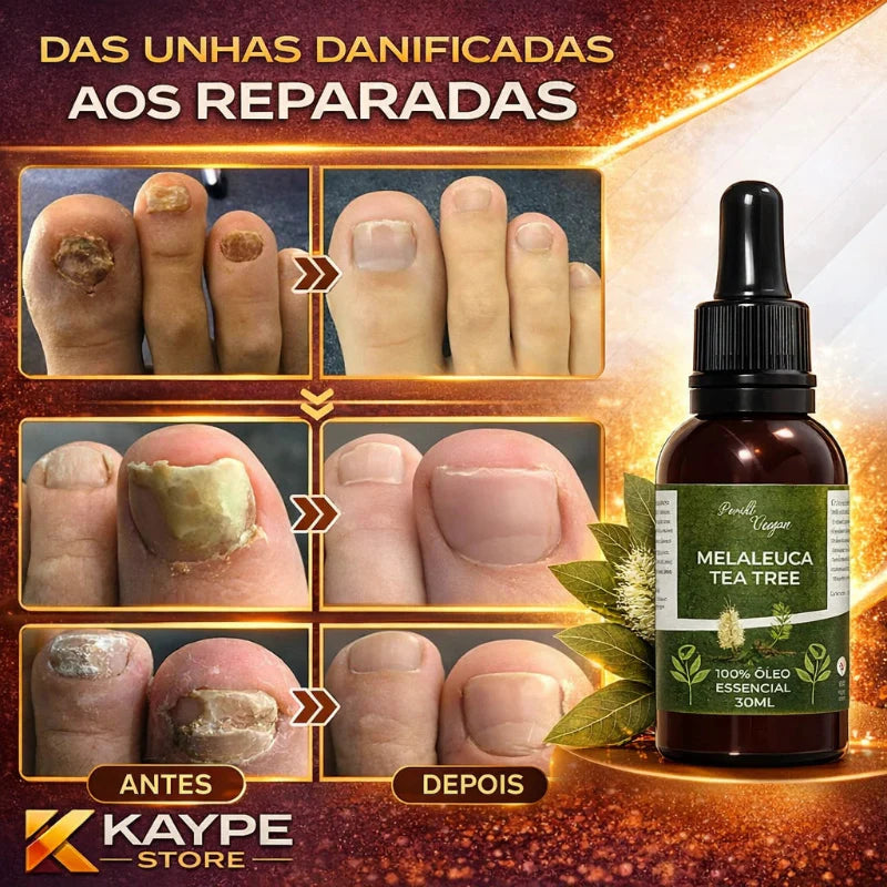 Óleo Reparador de Unha Melaleuca - Anti Fungo e Micose | 30ml