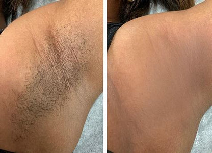 Sabonete Clareador de Virilhas e Axilas Com Vitamina C e Ácido Kójico