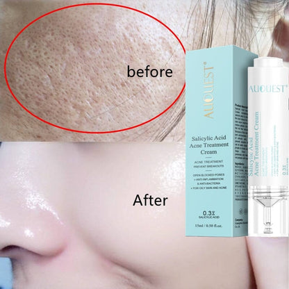 Sérum Para Tratamento Anti-Acne Com Ácido Salicílico 15ML Skin Care