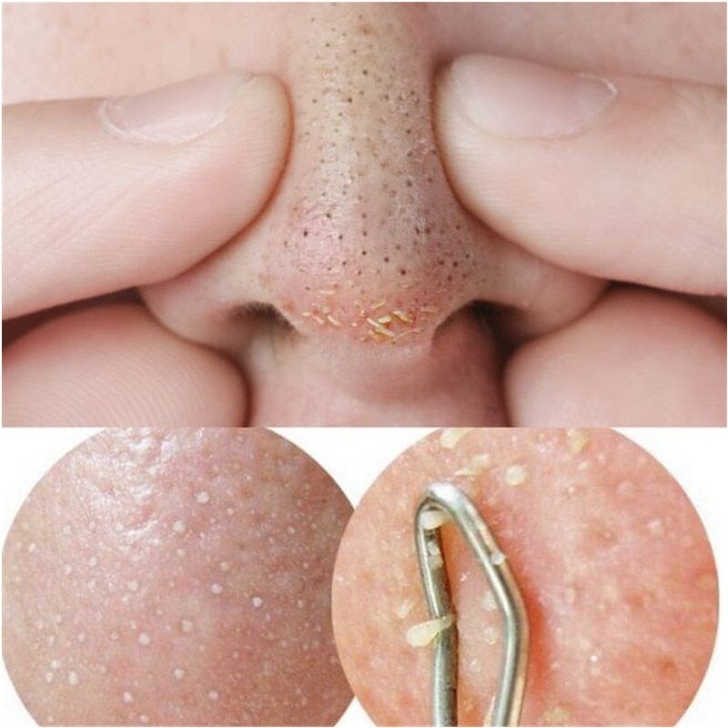Sérum Para Tratamento Anti-Acne Com Ácido Salicílico 15ML Skin Care