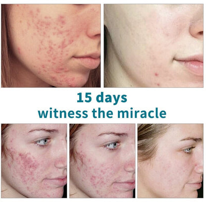 Sérum Para Tratamento Anti-Acne Com Ácido Salicílico 15ML Skin Care
